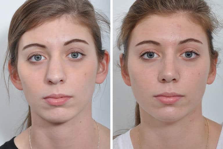 Rhinoplasty Is Not As Difficult As You Might Think
