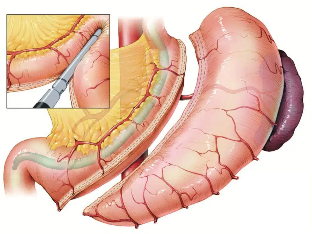 What is Gastric Sleeve Surgery or Sleeve Gastrectomy?