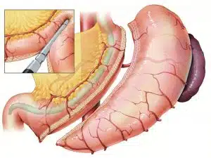 What is Gastric Sleeve Surgery or Sleeve Gastrectomy?