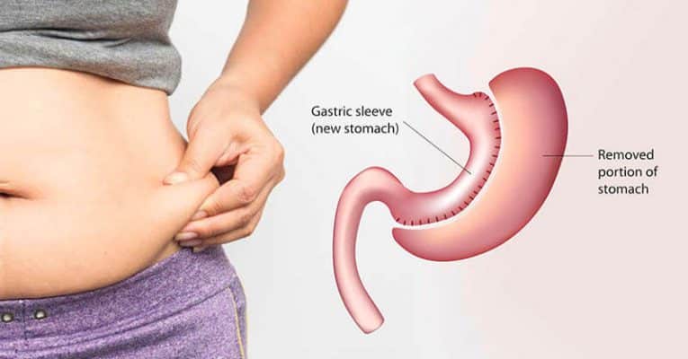 What are gastric sleeve surgery complications and side effects?