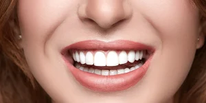 What is 3D Hollywood Smile?