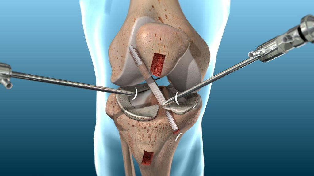 Knee ACL and PCL damage: Repair or Reconstructive Surgery?