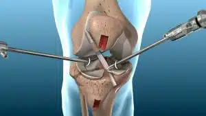 Knee ACL and PCL damage: Repair or Reconstructive Surgery?