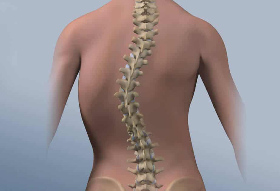 Scoliosis treatment in Iran