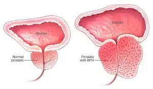 All you need to know about Transurethral resection of the prostate (TURP)!