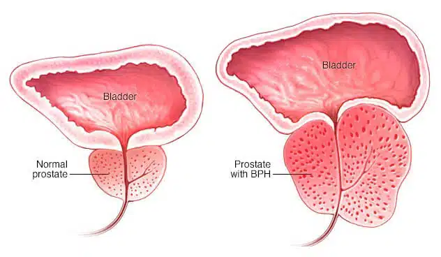 All you need to know about Transurethral resection of the prostate (TURP)!
