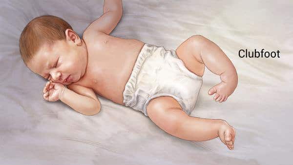 Everything about Clubfoot