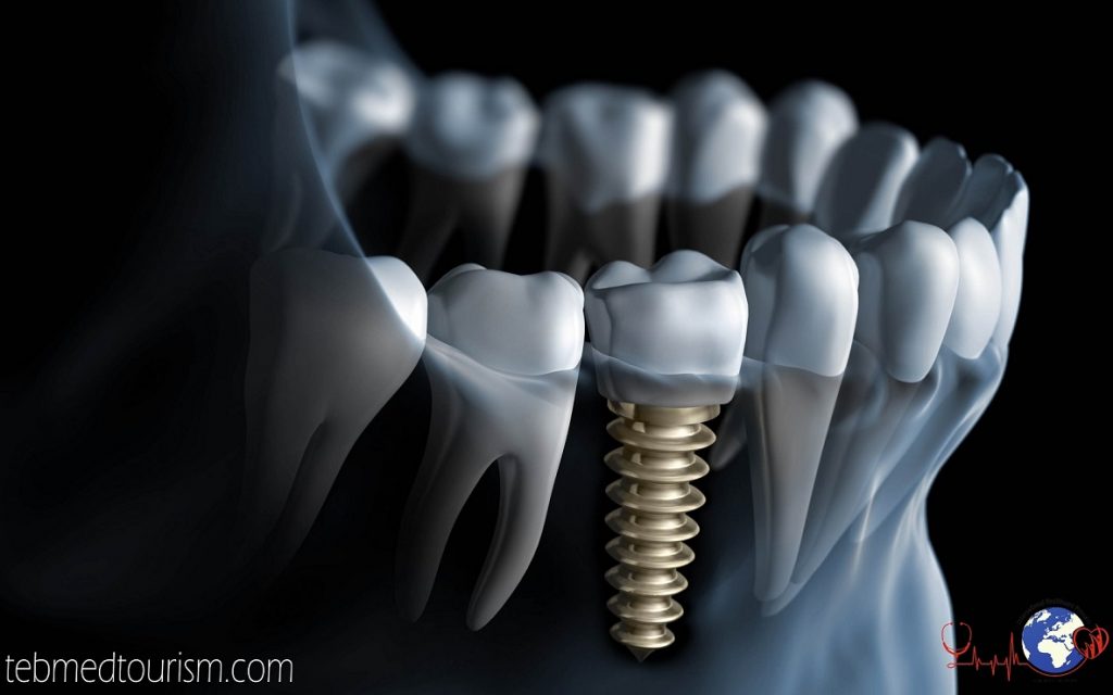 Dental Implant