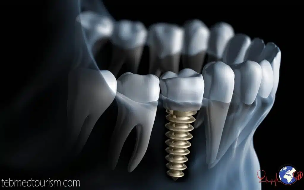 Dental Implant