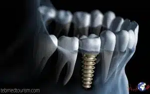 Dental Implant