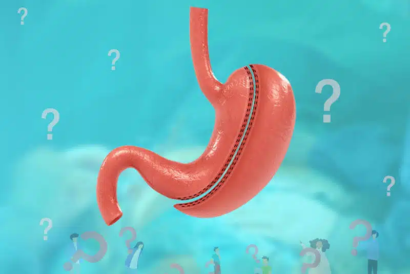 Gastric Sleeve Recovery