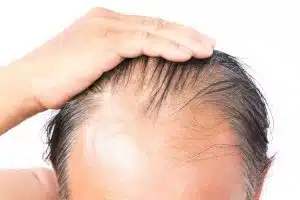 Hair Shedding or balding after a Hair Transplant