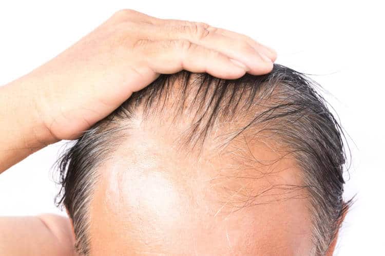 Hair Shedding or balding after a Hair Transplant
