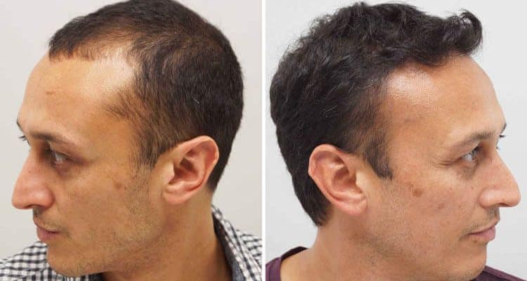 Hair transplant without head shaving or Micro FIT