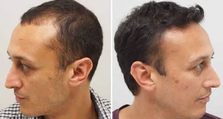 Hair transplant without head shaving or Micro FIT