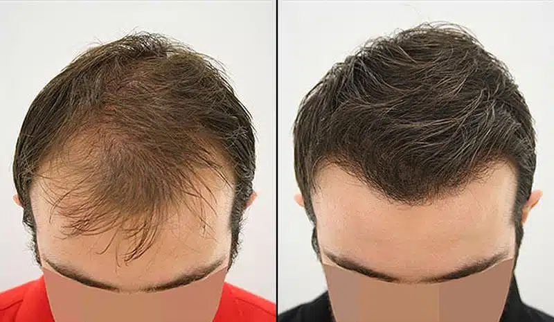 The Success rate of hair transplant surgery in Iran