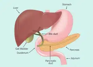 Laparoscopic cholecystectomy in Iran