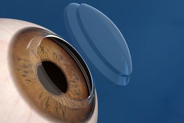 All you need to know about Corneal Transplant