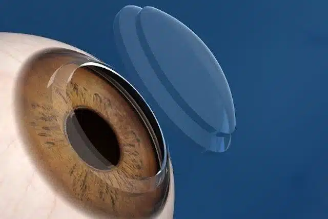 All you need to know about Corneal Transplant