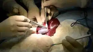 Open Cholecystectomy Surgery for Gallstones