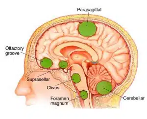 Brain tumor surgeries in Iran