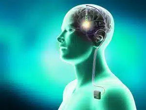 Introducing Deep Brain Stimulation (DBS) to Treat Parkinson Disease