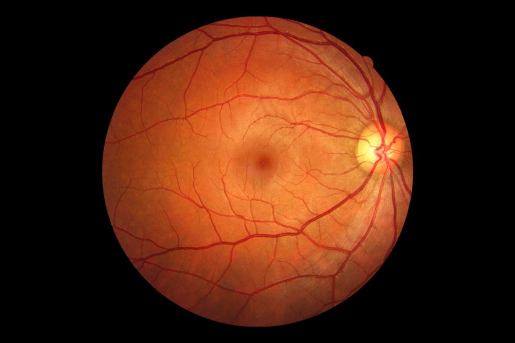 Two common eye diseases: Retinopathy and Retinal detachment (RD)