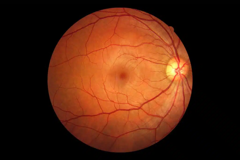Two common eye diseases: Retinopathy and Retinal detachment (RD)
