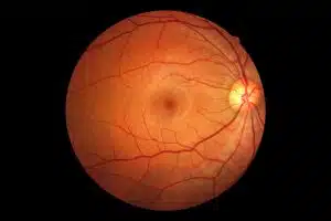 Two common eye diseases: Retinopathy and Retinal detachment (RD)