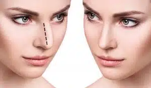 now Rhinoplasty Risks For Better Post-Operative Care
