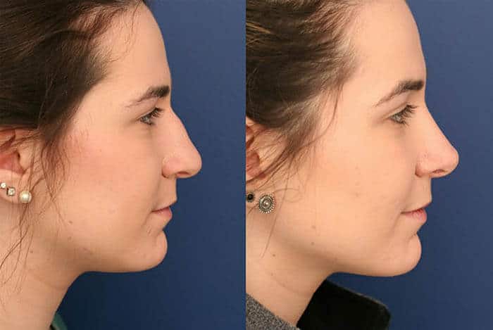 Notes to Find The Best Rhinoplasty Surgeon