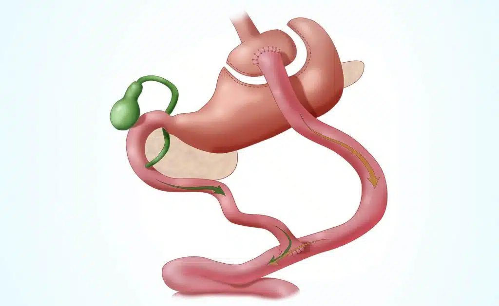 Bariatric Weight Loss Surgery or Gastric Bypass Surgery
