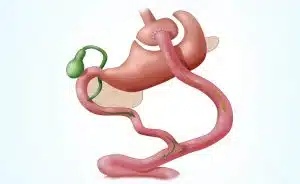 Bariatric Weight Loss Surgery or Gastric Bypass Surgery