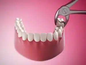قلع الاسنان المتضررة في ايران