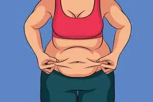 جراحة تخفيف الوزن بطريقة تكميم المعدة (SLEEVE) في ايران
