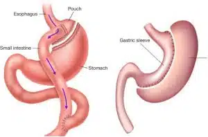 What is the difference between gastric sleeve and gastric bypass surgery?