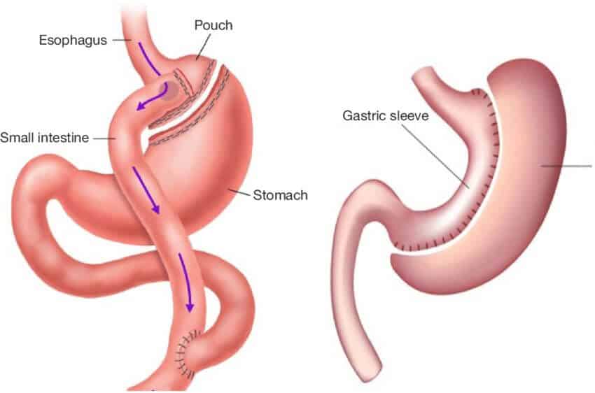 What is the difference between gastric sleeve and gastric bypass surgery?