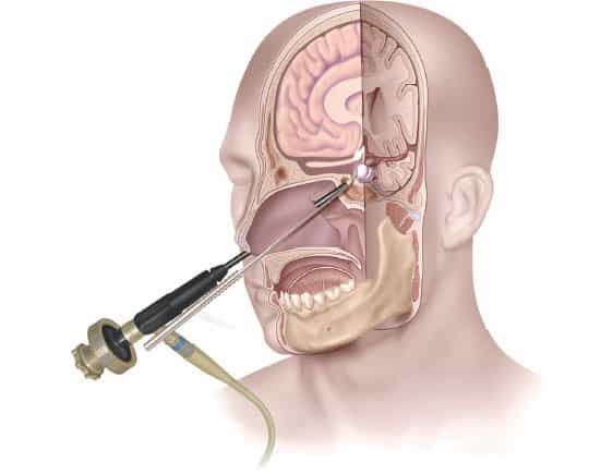 Endoscopic Brain Surgery in Iran