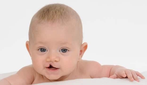 شکاف لب یکطرفه: انواع، دلایل و ترمیم