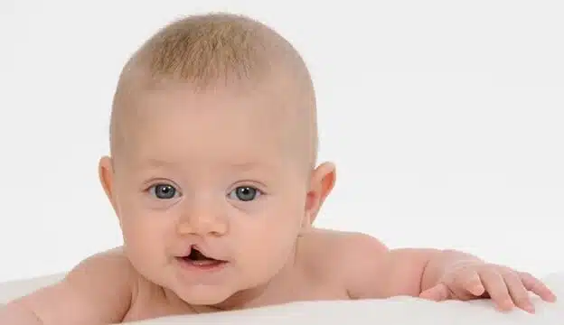 شکاف لب یکطرفه: انواع، دلایل و ترمیم