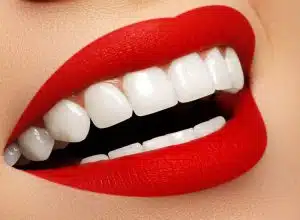 Hollywood Smile in Iran