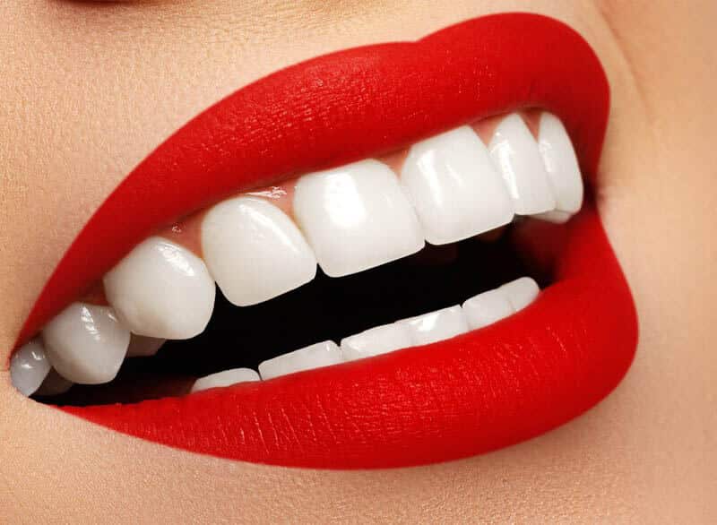 Hollywood Smile in Iran