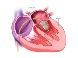 استبدال صمام القلب الأبهري و صمام التاجي