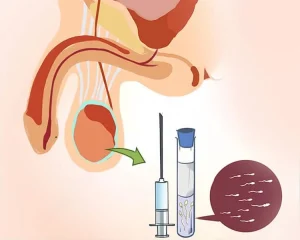 استخراج الحيوانات المنوية من الخصية TESE