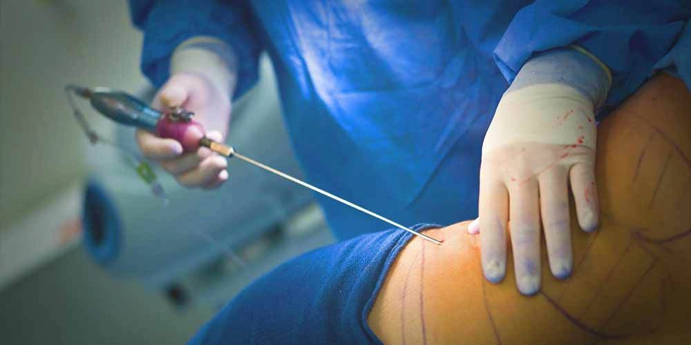 چگونه از شر تجمع مایعات و تورم بعد از لیپوساکشن خلاص شویم؟