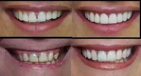 Advantages of Hollywood smile
