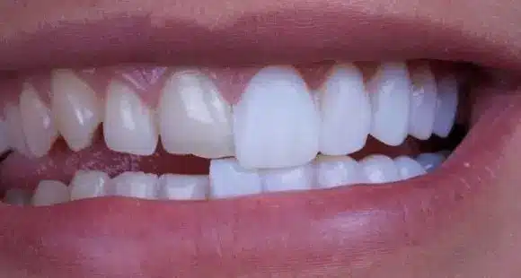 Bright and whitened teeth