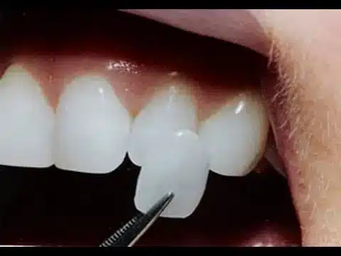Gingivitis