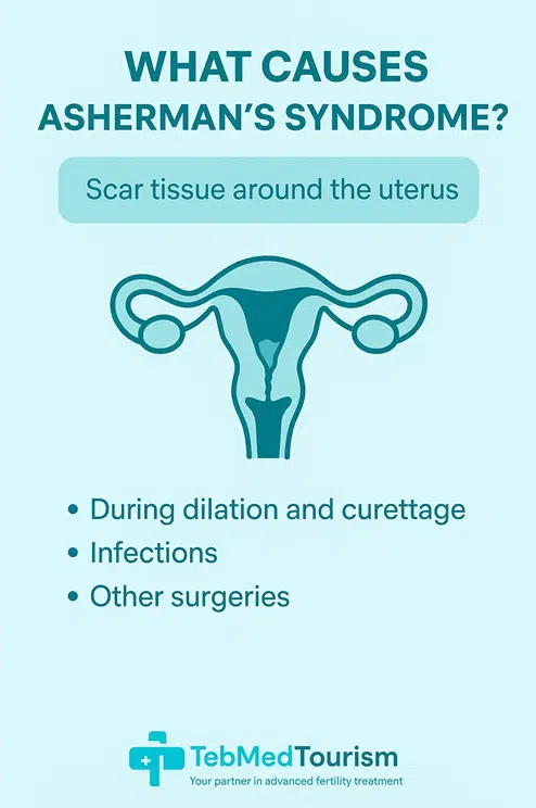 Asherman's syndrome is caused by adhesions, or scar tissue, that accumulate inside the uterus, constricting its interior space and sometimes blocking the cervix.