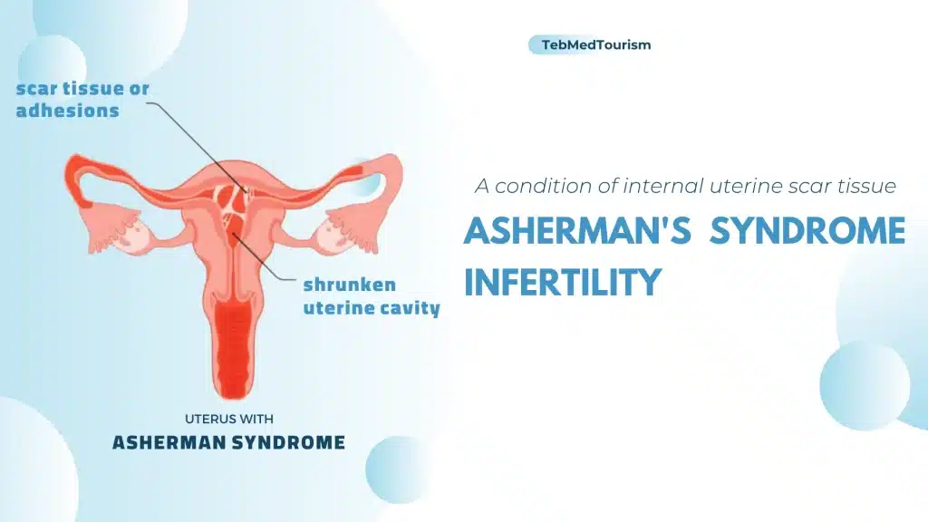 What is Asherman's Syndrome?